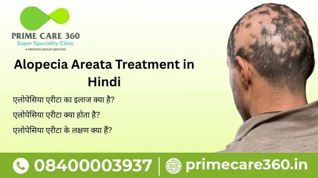 Alopecia Areata Treatment in Hindi