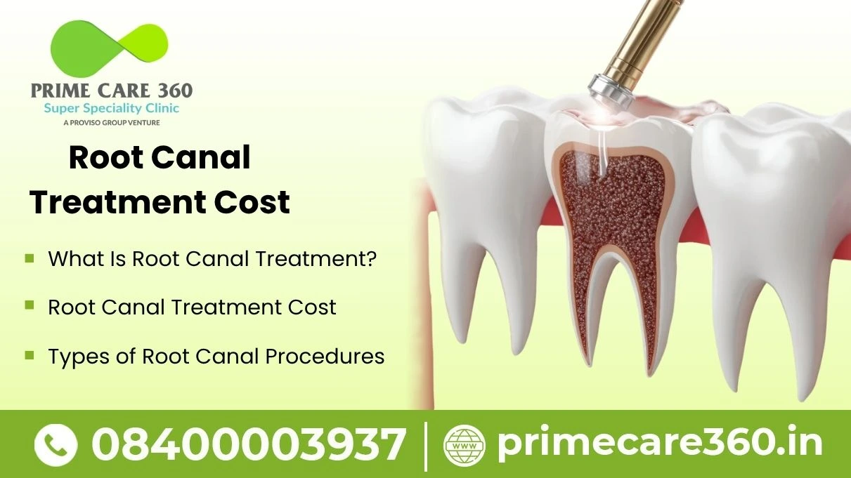 root canal treatment cost​