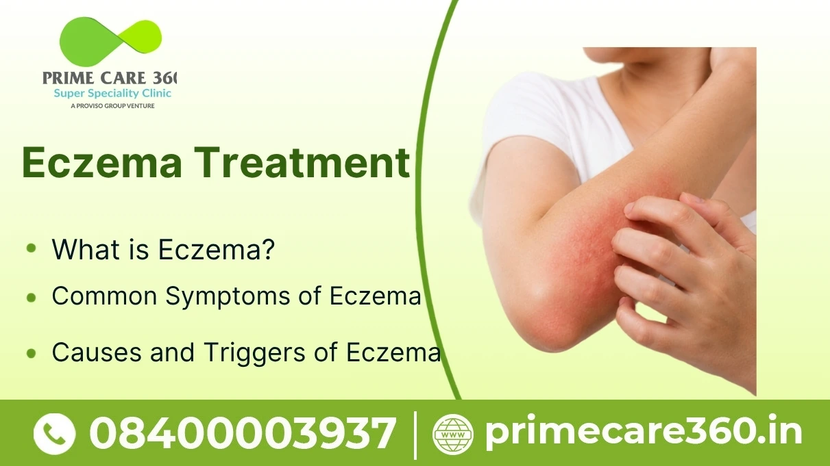 Eczema Treatment