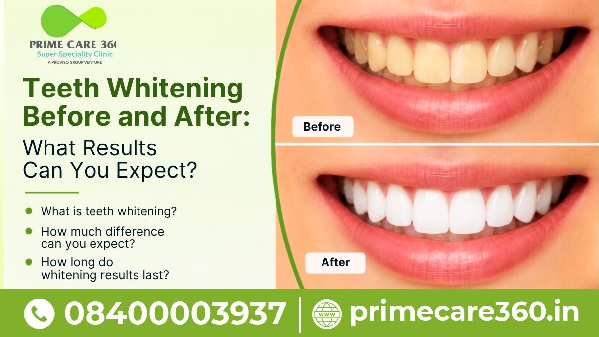 Before and after teeth whitening comparison showing stained teeth transformed into a brighter, whiter smile with Prime Care 360 Super Speciality Clinic branding, contact number, and website.